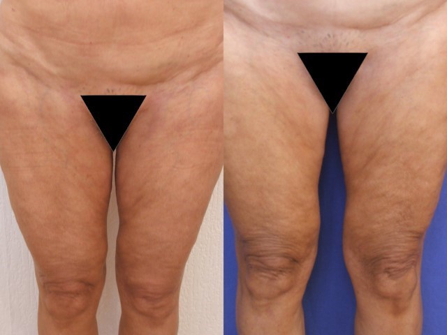 Lifting cuisses