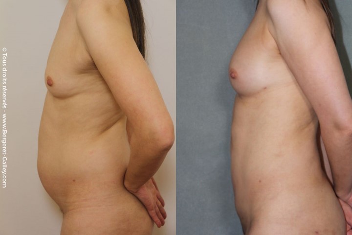 ملء الثدي بالدهون