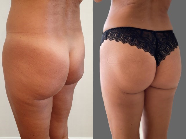 Avant/Après augmentation avec implants - Prothèses de fesses | Paris
