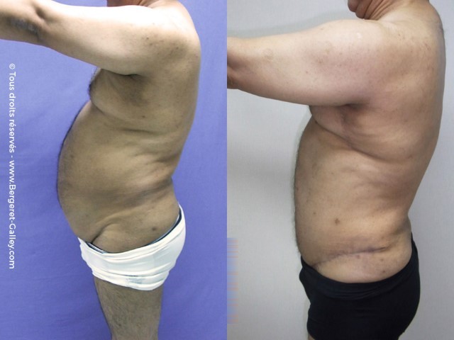 Before/After Bodylift for man