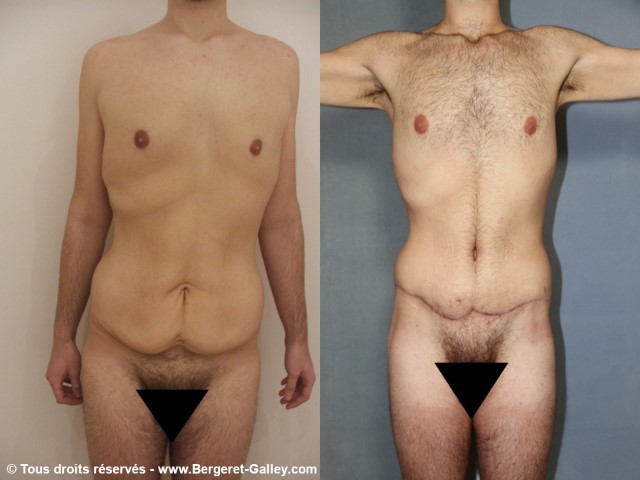 Before/After Bodylift for man