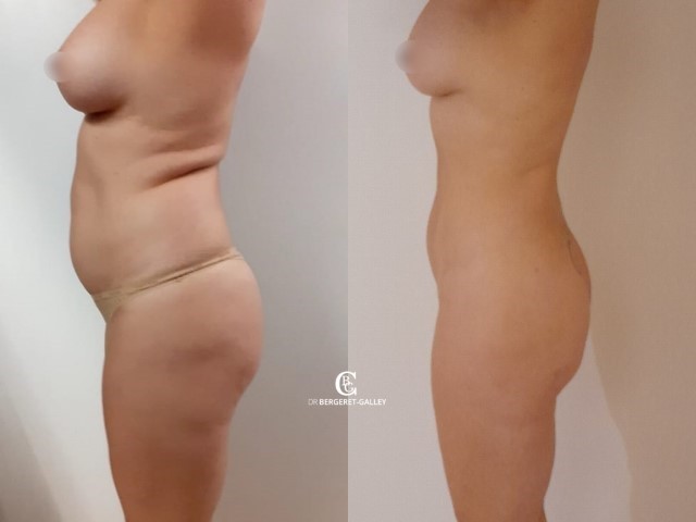 Liposuccion, lipofilling fesses