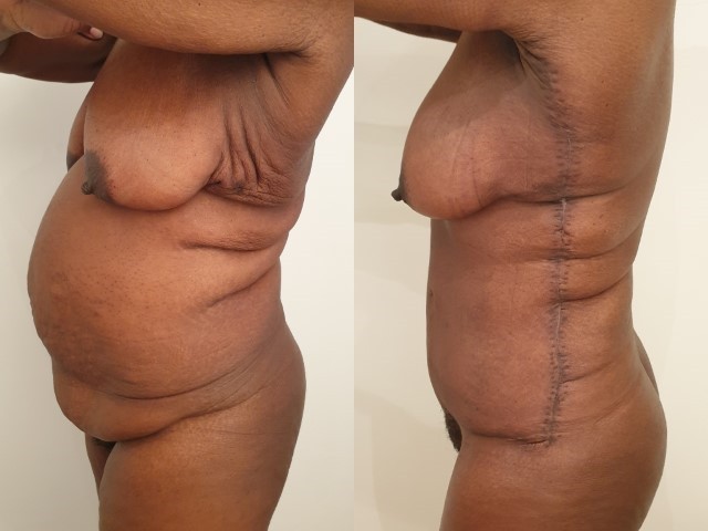 Bodylift