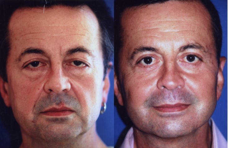 شد الخيوط