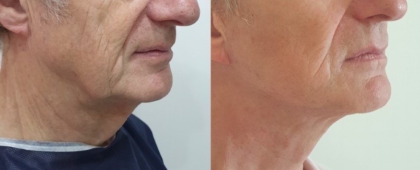 lifting-relachement-ovale-visage