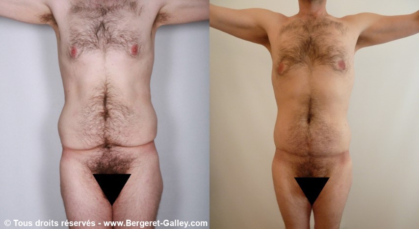 Bodylift for man