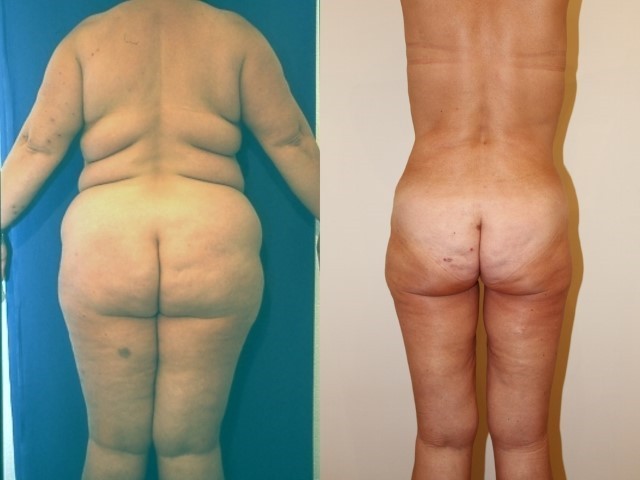 Lifting cuisses