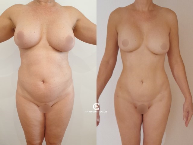 Liposuccion, lipofilling fesses