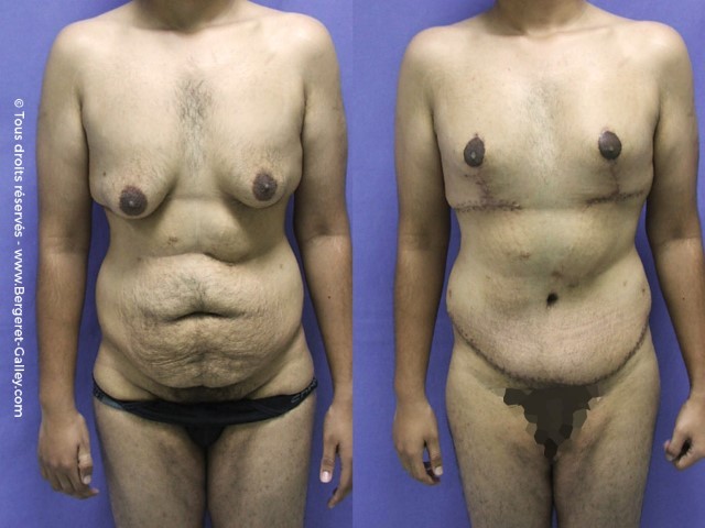 Before/After Bodylift for man