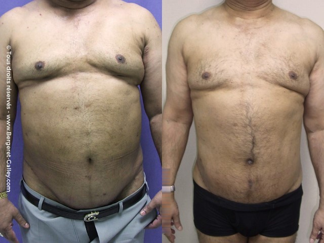 Before/After Bodylift for man