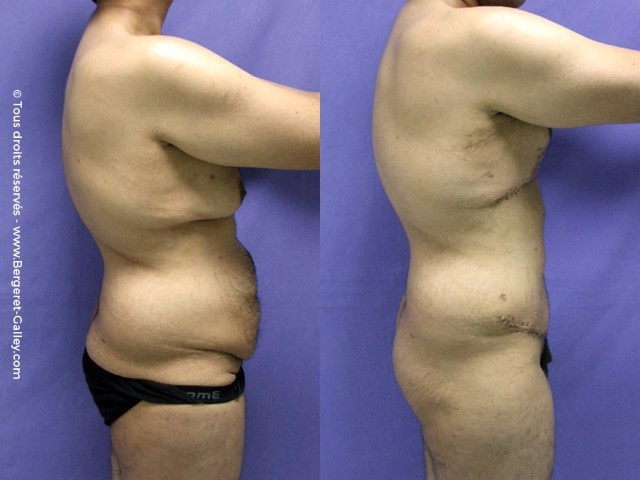 Before/After Bodylift for man