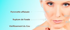 Thread Lift