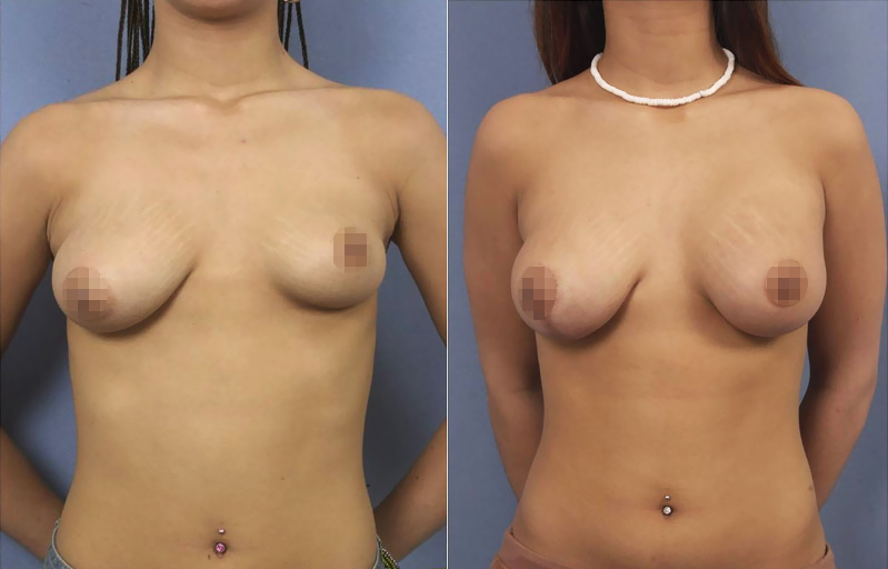 Augmentation des seins avec prothèse mammaire