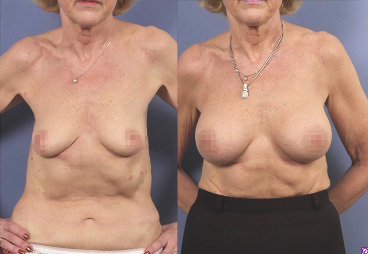 Augmentation mammaire