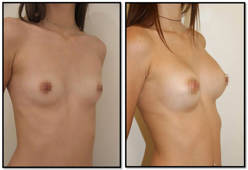 Chirurgie esthétique de la poitrine avec prothèse mammaire de 250ml
