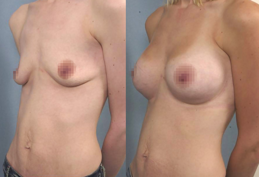 Photo avant/après augmentation mammaire avec des prothèses 260ml