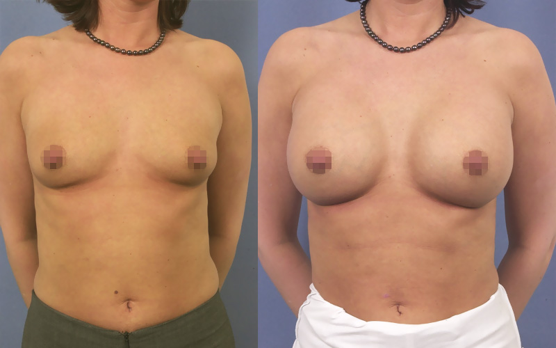 Avant et après une augmentation mammaire (prothèse 350ml)