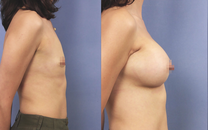 Avant et après une augmentation des seins (profil)