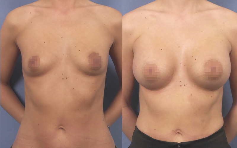 Résultat d'une augmentation mammaire avec des prothèses 350ml de face
