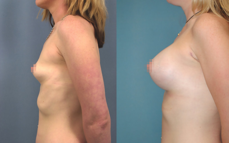 Photo avant/après d'une augmentation mammaire avec des prothèses 350ml (profil)