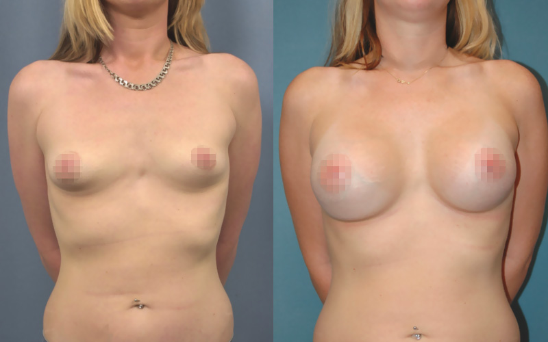 Photo avant/après d'une augmentation mammaire avec des prothèses 350ml (face)