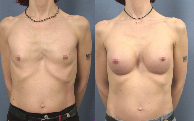 Photo avant/après une augmentation mammaire avec des prothèses suite une malformation congénitale (face)