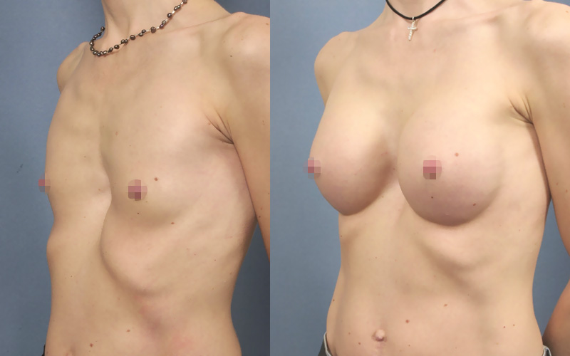 Photo avant/après une augmentation mammaire avec des prothèses suite une malformation congénitale (profil)