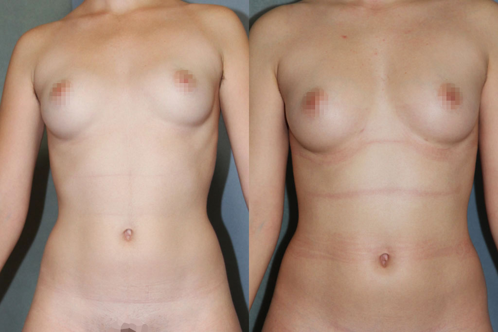 Lipofilling ou lipostructure : augmentation mammaire par injection de graisse autologue