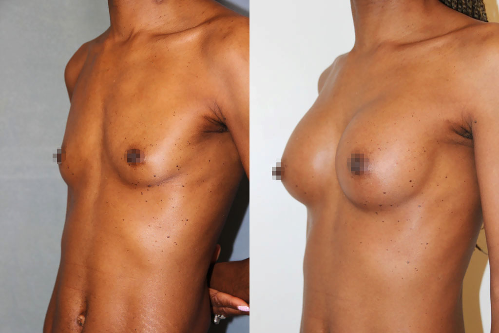 Augmentation mammaire par lipofilling (1/3)