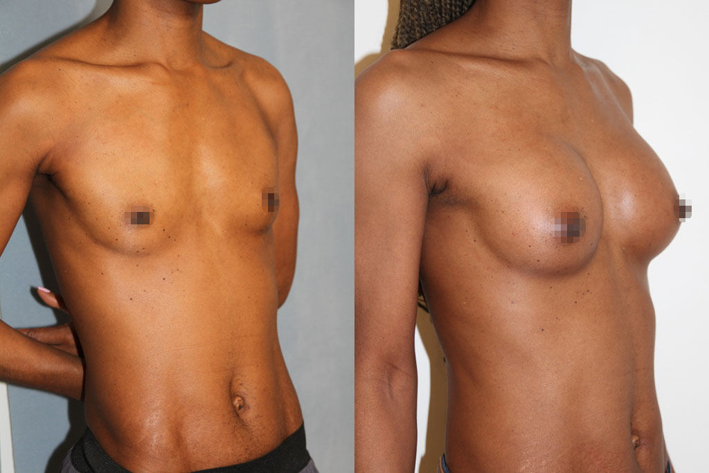 Augmentation mammaire par lipostructure (2/3)