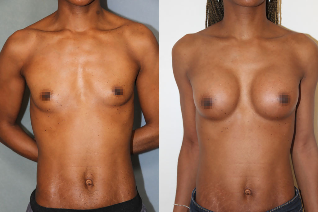 Lipofilling des seins (3/3)