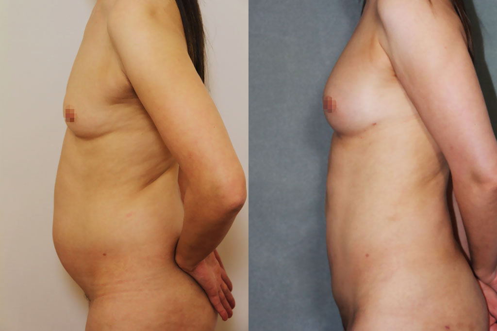 Lipoaspiration et lipofilling avec Body Jet
