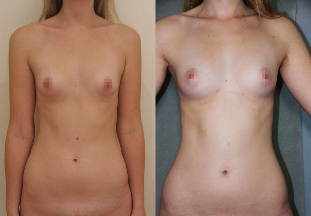 Lipoaspiration et réinjection de graisse avec Body Jet