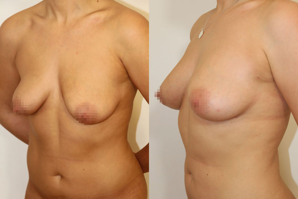 Lipofilling des seins après une ptôse (1/3)