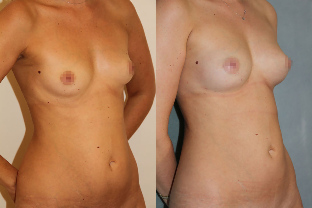 Lipostructure avec Body Jet (3/3)