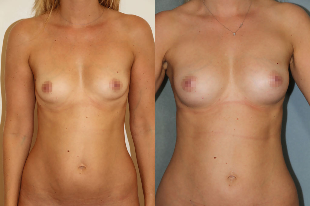 Lipoaspiration suivi d'un lipofilling avec Body Jet (2/3)