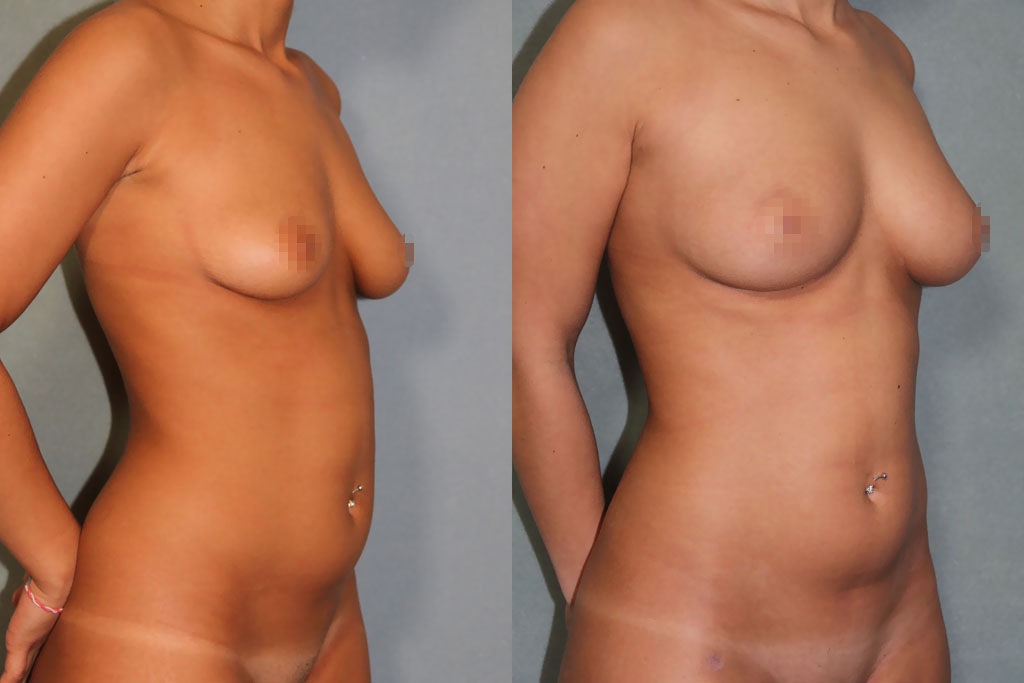 Lipostructure des seins après une ptôse mammaire (2/3)