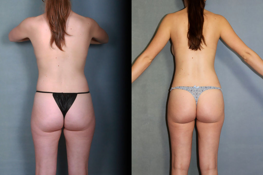 Liposuccion des hanches et cuisses pour lipofilling des seins (1/3)