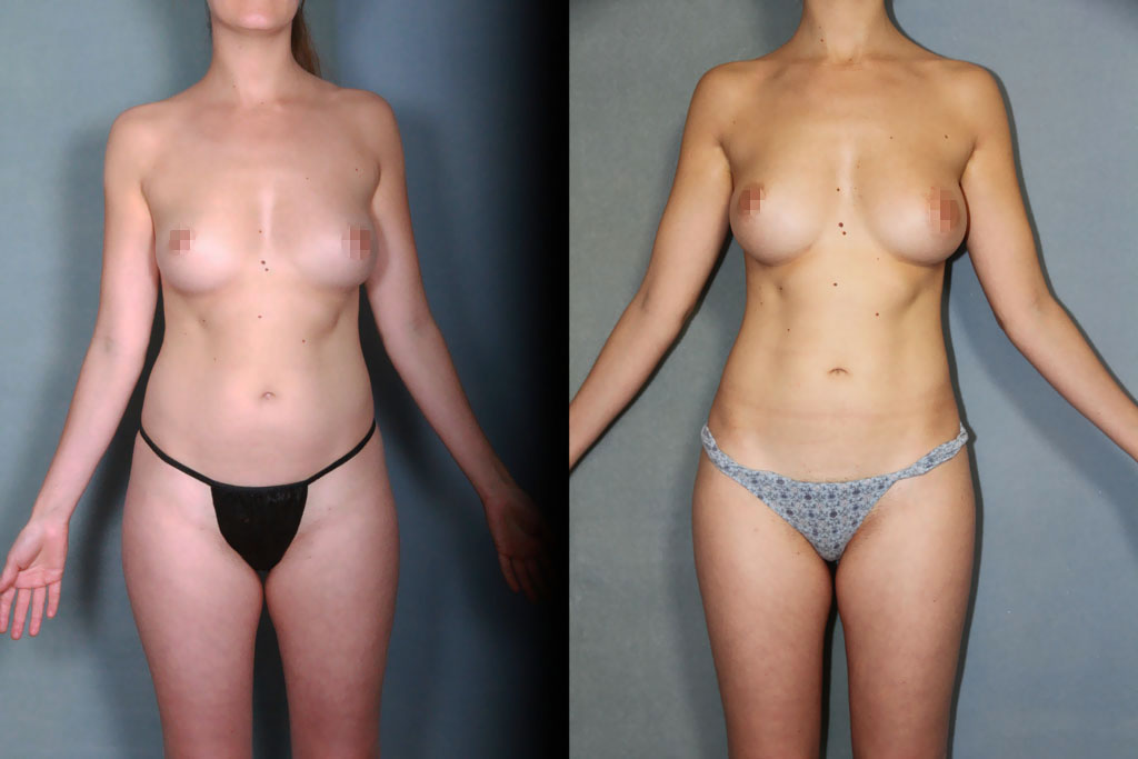 Lipoaspiration des hanches et cuisses pour lipofilling des seins (2/3)