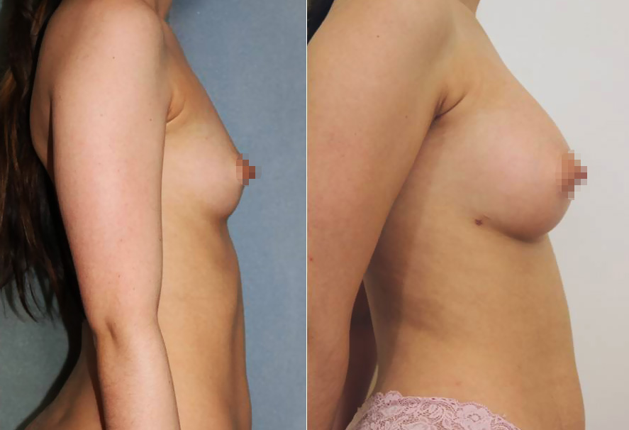 Lipofilling ou lipostructure : augmentation mammaire par injection de votre propre graisse