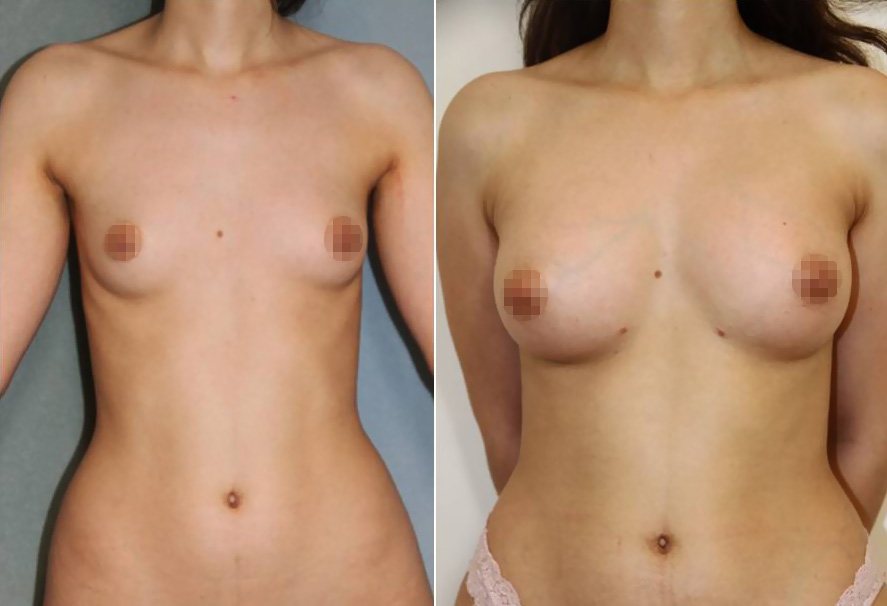 Lipofilling ou lipostructure : augmentation mammaire par injection de votre propre graisse