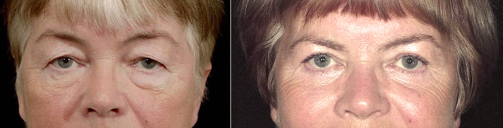 Chirurgie des paupières chez une femme
