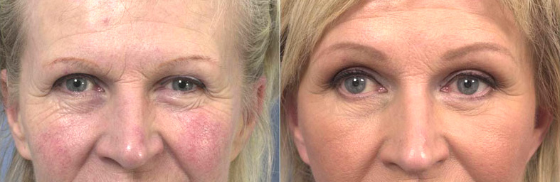 Résultat d'une blépharoplastie chez une femme