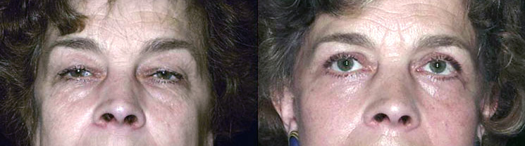 Résultat d'une blépharoplastie pour une femme