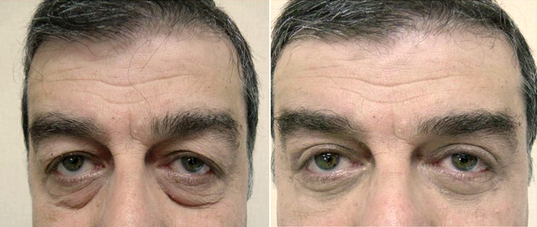 Blepharoplastie