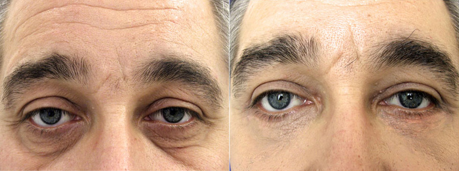 Résultat d'une blépharoplastie chez un homme, zone des yeux