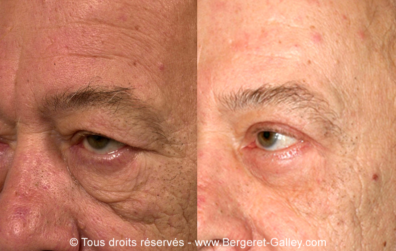 Blépharoplastie chez un homme (2/2 de trois quarts)