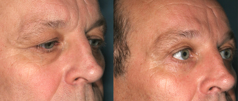 Résultat d'une blépharoplastie chez un homme