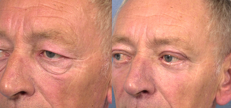 Blépharoplastie homme