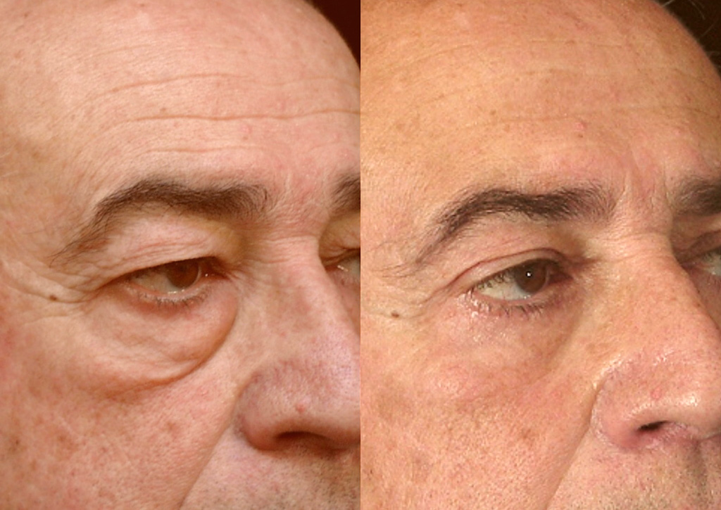 Résultat d'une blépharoplastie pour un homme (2/2 trois quarts)